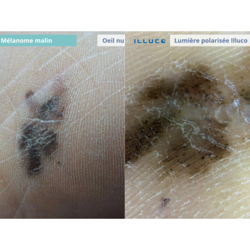 Dermatoscope Illuco usb IDS 1100