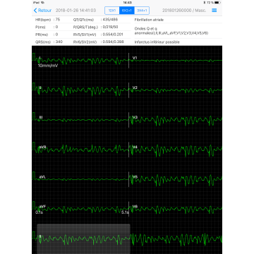 Electrocardiographe ECG Edan PADECG Numérique sans fil pour iPad avec interprétation